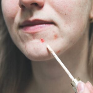 What is the Famous Treatment for Acne?