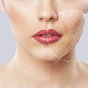 What procedure is best for large pores?