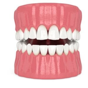 Can Composite Veneers Be Removed?