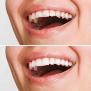 Can You Go Back to Normal Teeth After Veneers?