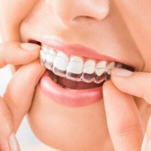 Can aligners push teeth back?