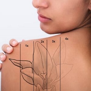 Can tattoos be removed permanently by laser?