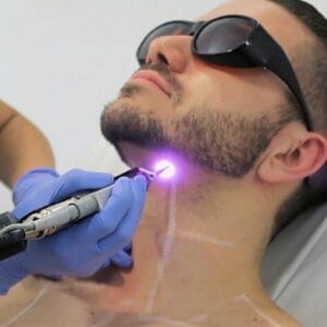 Does Skin Look Red After Laser Hair Removal?