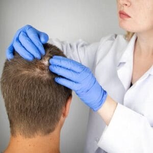 How Can I Permanently Cure Alopecia Areata?