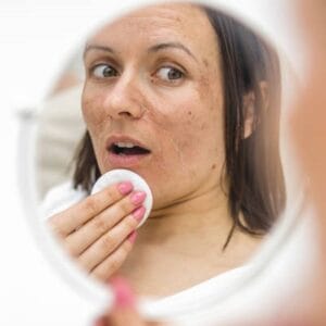 How do you remove melasma permanently?