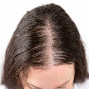 How do you treat permanent hair loss?