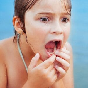 How to fix overlapping teeth without braces?