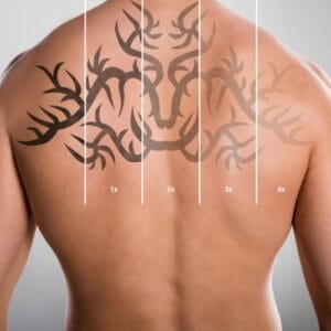 How to remove tattoos permanently in Islamabad?