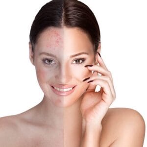 What Is the First Line Treatment for Rosacea?