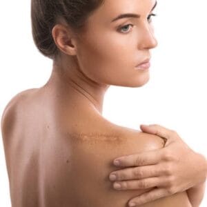 What is the best treatment for keloid skin?