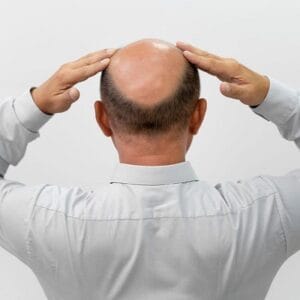 What is the most successful type of hair transplant?