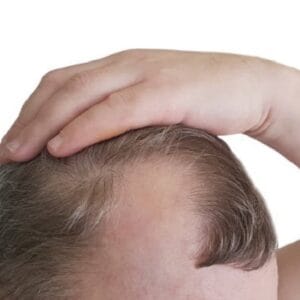 What is the recovery time for a FUT hair transplant?