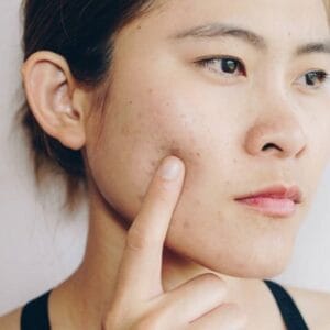 Can Laser Remove Acne Scars?