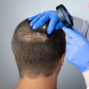 How to Stop Alopecia Areata From Spreading?