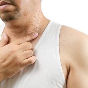 Is laser skin tag removal safe?