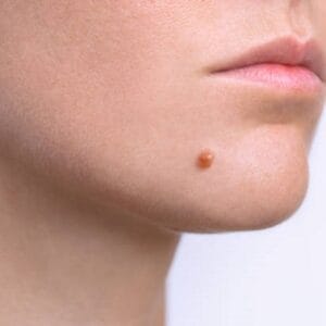 Is mole removal surgery safe in Islamabad?