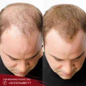 Mesotherapy For Hair Loss (1)