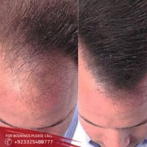 Mesotherapy For Hair Loss in Islamabad