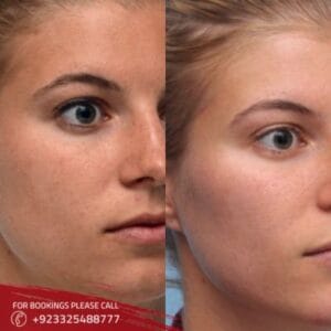 Organic Fillers treatment (1)