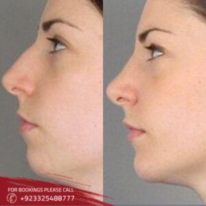Silicone nose surgery (1)