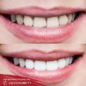 Teeth aligners