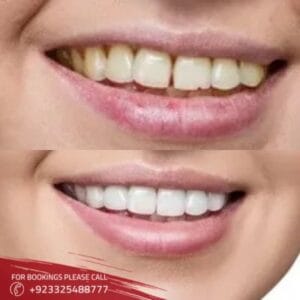 Teeth aligners in Islamabad
