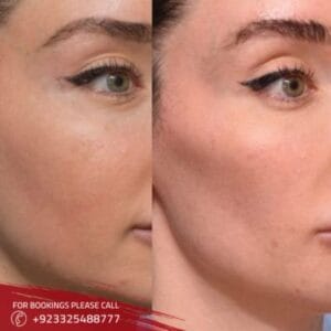 Volbella Filler in Islamabad