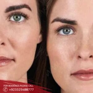 Volbella Filler treatment (1)