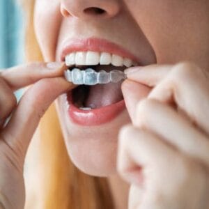 Want to Transform Your Smile with Clear Aligners in Islamabad?