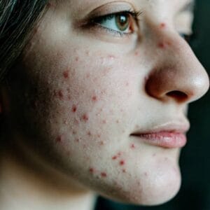 What Is the Strongest Treatment for Pimples in Islamabad?
