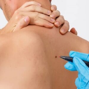 What is the most effective wart removal technique?