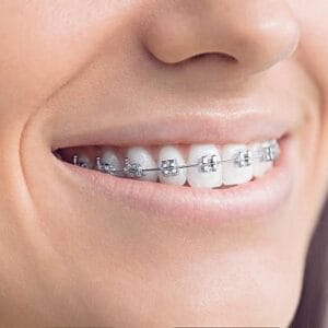 Which Braces Are Best for Teeth?