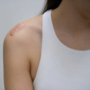 Which injection is good for keloids?