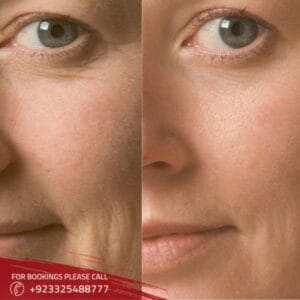 Wrinkle smoothing Treatment