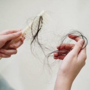 can liposuction cause hair loss?