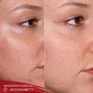 derma roller treatment in Islamabad