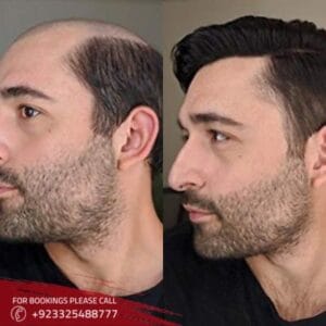 hair transplant