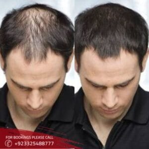 hair transplant in Islamabad