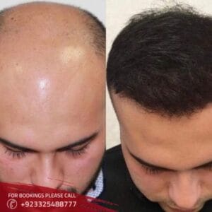 hair transplant treatment
