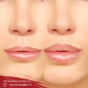 lip augmentation in Islamabad (1)