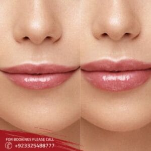 lip augmentation treatment (1)