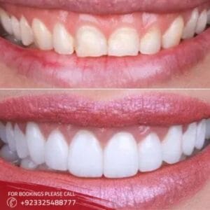 teeth aligners treatment in islamabad