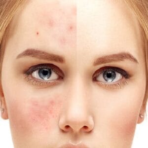 Can I permanently remove acne scars in Islamabad?
