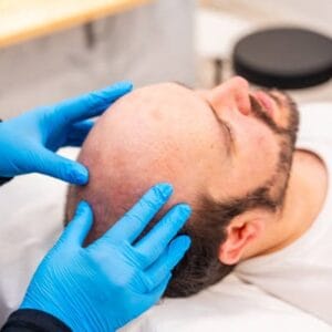 Does PRP Work Better Than a Hair Transplant?