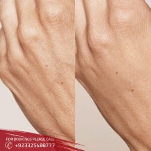 Hand Rejuvenation