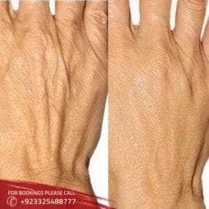 Hand Rejuvenation Treatment