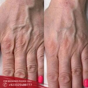 Hand Rejuvenation in Islamabad