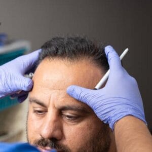 How Does a Hair Transplant Compare to Hair Loss Treatments