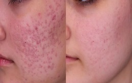 Acne Scar Removal result in Islamabad