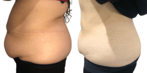 Aqualyx_Injection_Treatment_Islamabad